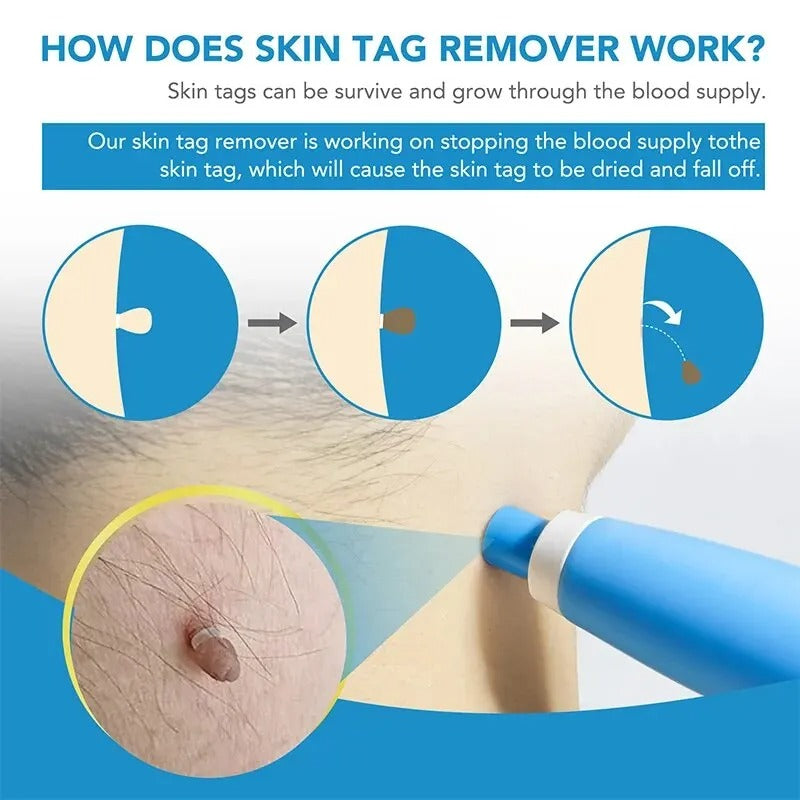 Skin Tag Care Kit - Gentle At-Home Applicator Bands
