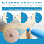 Skin Tag Care Kit - Gentle At-Home Applicator Bands