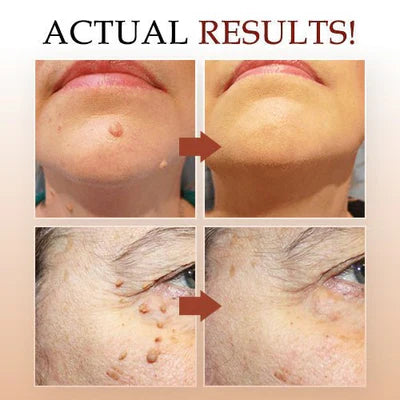 Skin Tag & Mole Care Applicator - At-Home Skin Care Tool