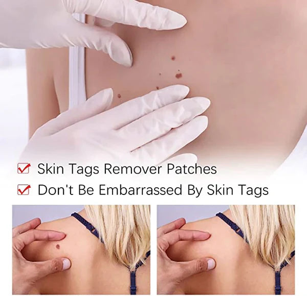 Skin Tag & Mole Care Applicator - At-Home Skin Care Tool