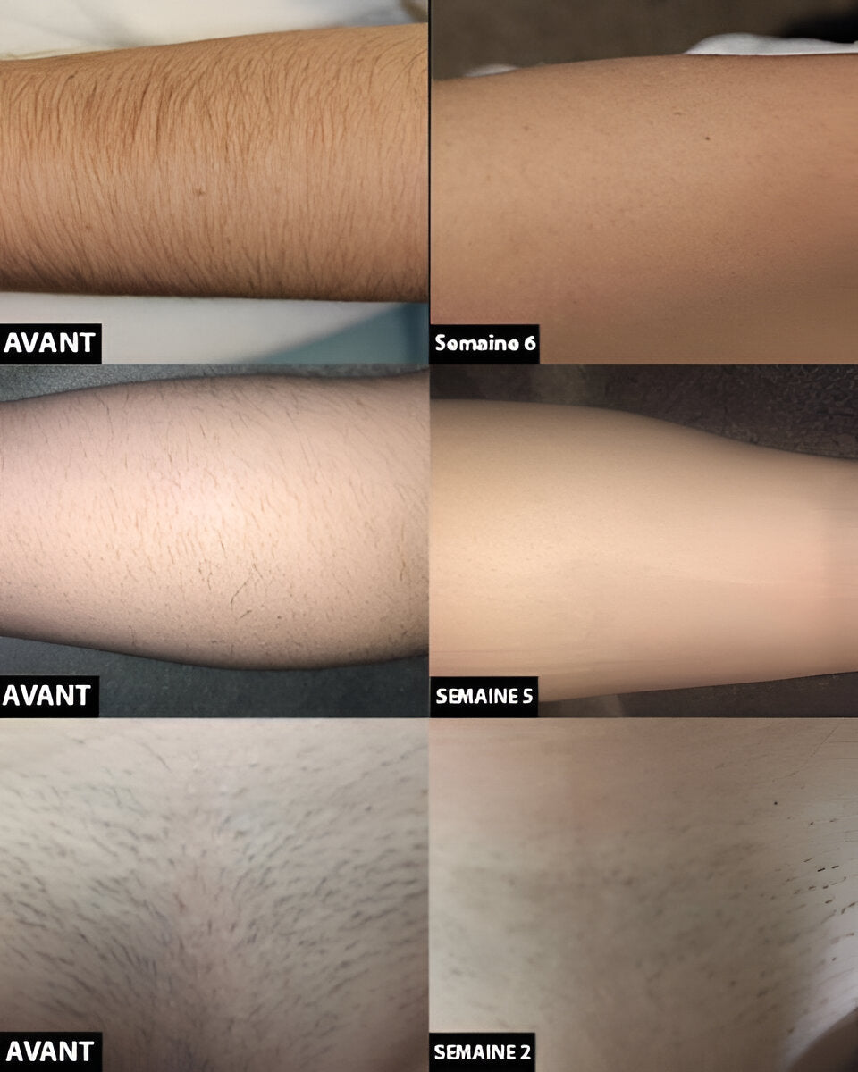 At-Home Laser Hair Removal Device - Gradual Hair Reduction