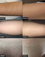 At-Home Laser Hair Removal Device - Gradual Hair Reduction
